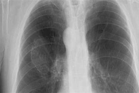 How long can you live with asbestos in your lungs?