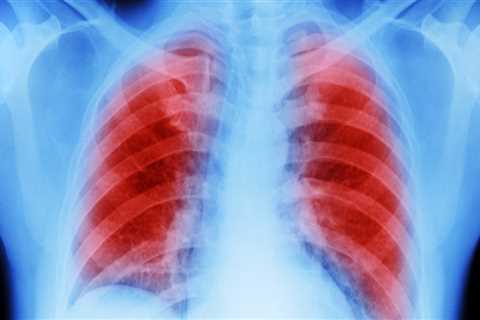 What lung disease is caused by asbestos?