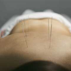 ACUPUNCTURE FOR STRESS AND ANXIETY RELIEF