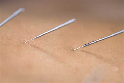 THE BENEFITS OF ACUPUNCTURE FOR MENOPAUSE-RELATED VAGINAL DRYNESS